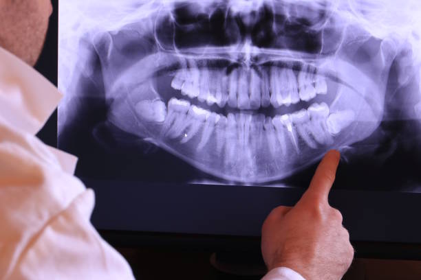 Best Emergency Wisdom Teeth Removal in Medford, MA